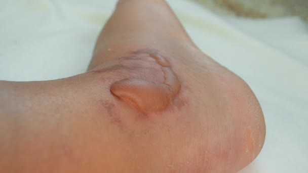 Swollen Leg Blisters Filled Fluid Frostbite Close Swollen Foot Fluid — Vídeo de stock