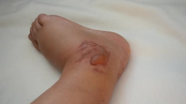 Swollen Leg Blisters Filled Fluid Frostbite Close Swollen Foot Fluid — Vídeo de Stock