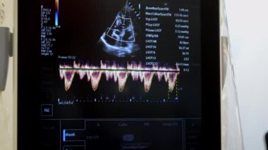 Utrasound image on the monitor close-up. Ultrasound Scan display. Ultrasound Scan Device. Echocardiography. Screening Ultrasonography Analysis of person. Ultrasound examination. Using Scanner.