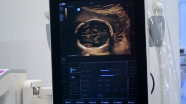 Utrasound image on the monitor close-up. Ultrasound Scan display. Ultrasound Scan Device. Echocardiography. Screening Ultrasonography Analysis of person. Ultrasound examination. Using Scanner.