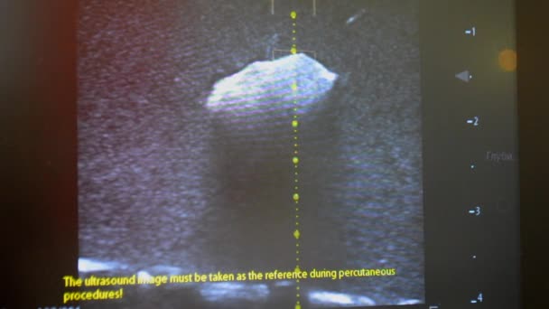 Obraz Usg Zbliżeniu Monitora Wyświetlacz Usg Echokardiografia Badanie Ultrasonograficzne Osoby — Wideo stockowe