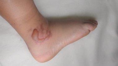 Swollen leg with blisters filled with fluid after frostbite close-up. Swollen foot with fluid-filled blisters from frostbite. Skin swollen in lumps. Foot with bloated. Disease sickness corn callus
