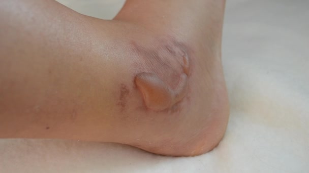 Swollen Leg Blisters Filled Fluid Frostbite Close Swollen Foot Fluid — ストック動画
