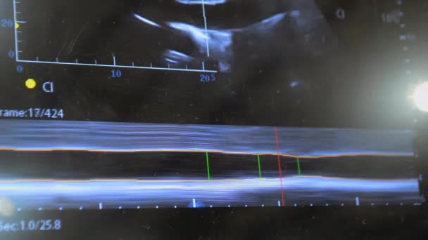 Utrasound Image Monitor Close Ultrasound Scan Display Ultrasound Examination Using — Stok Video