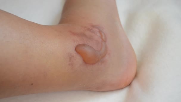 Swollen Leg Blisters Filled Fluid Frostbite Close Swollen Foot Fluid — Stock video