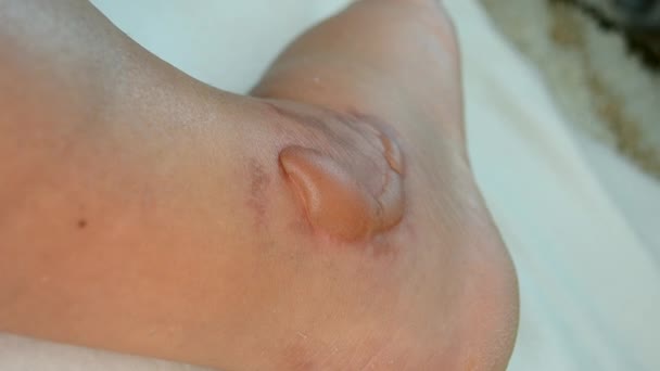 Swollen Leg Blisters Filled Fluid Frostbite Close Swollen Foot Fluid — Vídeo de stock