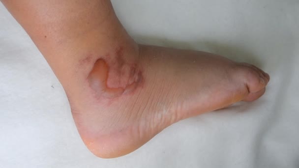 Swollen Leg Blisters Filled Fluid Frostbite Close Swollen Foot Fluid — Vídeos de Stock