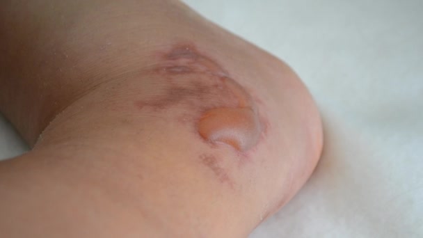 Swollen Leg Blisters Filled Fluid Frostbite Close Swollen Foot Fluid — Vídeos de Stock