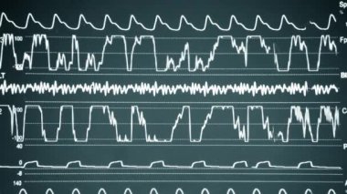 Modern hasta gözlemcisi. Elektronik Sağlık Monitörü, tıbbi göstergeler ve hastanın hayati aktivitelerinin grafiklerini gösteriyor. Hayati belirtileri var. Hastanede bilgisayar monitörü var. Kardiyogram ECG Nabzı