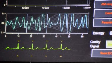 Modern hasta gözlemcisi. Elektronik Sağlık Monitörü, tıbbi göstergeler ve hastanın hayati aktivitelerinin grafiklerini gösteriyor. Hayati belirtileri var. Hastanede bilgisayar monitörü var. Kardiyogram ECG Nabzı
