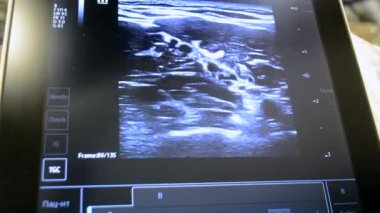 Ultrason monitörde. Bilgisayar monitöründeki ultrason görüntüsü yakın plan. Ultrason muayenesi. Sonografi sonogramı. Ultrasonografi ultrasonik. Tanısal sağlık sisteminin izlenmesi