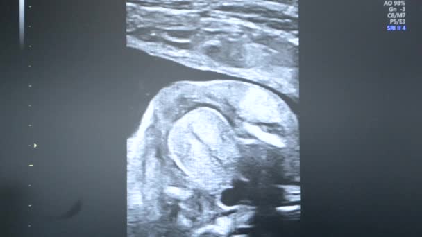 Usg Monitorze Obraz Ultradźwiękowy Ekranie Komputera Zbliżenie Badanie Ultrasonograficzne Usg — Wideo stockowe