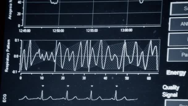 현대의 모니터 지표와 환자의 그래프를 감시자 의학적 바이탈 사인이야 병원에 — 비디오