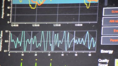 Modern hasta gözlemcisi. Elektronik Sağlık Monitörü, tıbbi göstergeler ve hastanın hayati aktivitelerinin grafiklerini gösteriyor. Hayati belirtileri var. Hastanede bilgisayar monitörü var. Kardiyogram ECG Nabzı