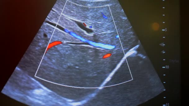 监视器上的超声波计算机显示器屏幕上的超声波图像的特写 超声波检查 声像图 超声超声检查 监测诊断性医疗保健系统 — 图库视频影像
