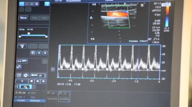 Modern hasta gözlemcisi. Elektronik Sağlık Monitörü, tıbbi göstergeler ve hastanın hayati aktivitelerinin grafiklerini gösteriyor. Hayati belirtileri var. Hastanede bilgisayar monitörü var. Kardiyogram ECG Nabzı
