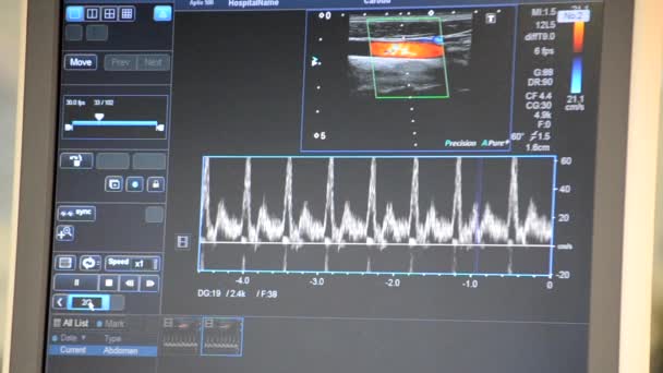 現代の患者モニター 電子健康モニターは 医療指標や患者の重要な活動のグラフを表示します 医療上の重要な兆候 病院内のコンピュータモニタの画面 心臓図 Ecg Pulse — ストック動画