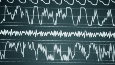 Modern hasta gözlemcisi. Elektronik Sağlık Monitörü, tıbbi göstergeler ve hastanın hayati aktivitelerinin grafiklerini gösteriyor. Hayati belirtileri var. Hastanede bilgisayar monitörü var. Kardiyogram ECG Nabzı