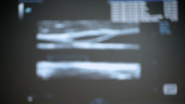 模糊的背景 监视器上的Utrasound图像 超声波扫描显示 对人进行超声扫描分析 用扫描仪进行超声波检查 超声波扫描装置 超声心动图 — 图库视频影像