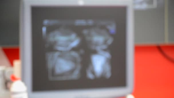 Arka Plan Bulanık Ultrason Görüntüsü Ekranda Ultrason Görüntüsü Kişinin Ultrasonografi — Stok video