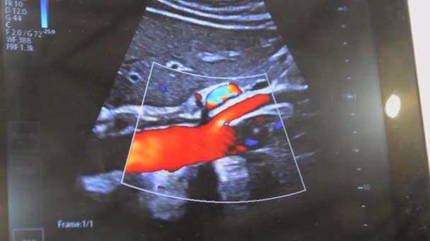 Utrasound Image Monitor Close Ultrasound Scan Display Screening Ultrasonography Analysis — Vídeo de stock