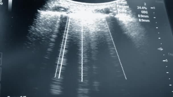 Ultraljud Monitorn Ultraljudsbild Bildskärmen Närbild Övervakning Diagnostisk Sjukvård Sonografisonogram Ultraljudsundersökning — Stockvideo