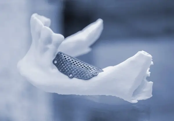 stock image Prototype of lower human jaw with medical titanium implant from biocompatible titanium printed on 3D printer. Maxillo-facial prosthesis anatomical human bone from metal powder