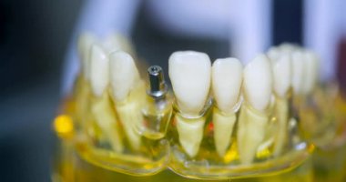 Yakın plan implantları olan şeffaf İnsan Dişleri Modeli. Diş implantı kurulumu. Ön azı dişi implantı yerleştirilmiş çene