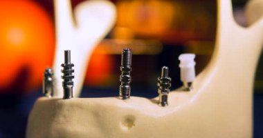 Yakın plan implantları olan şeffaf İnsan Dişleri Modeli. Diş implantı kurulumu. Ön azı dişi implantı yerleştirilmiş çene