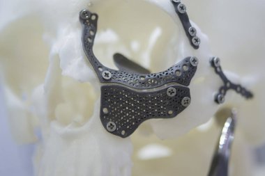 Üç boyutlu yazıcıya basılmış, plaka şeklinde titanyum implantları ve cerrahi şablonlar olan beyaz plastik insan kafatası prototipi. Biyoentegre protez. Sağlık sigortası