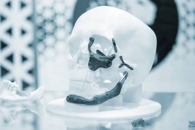 Üç boyutlu yazıcıya basılmış, plaka şeklinde titanyum implantları ve cerrahi şablonlar olan beyaz plastik insan kafatası prototipi. Biyoentegre protez. Sağlık sigortası
