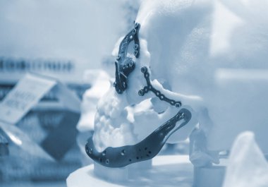 Üç boyutlu yazıcıya basılmış, plaka şeklinde titanyum implantları ve cerrahi şablonlar olan beyaz plastik insan kafatası prototipi. Biyoentegre protez. Sağlık sigortası