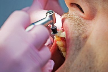 Diş hekimi hastaya ön diş tedavisi uygular.