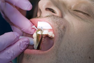 Diş hekimi hastaya ön diş tedavisi uygular.