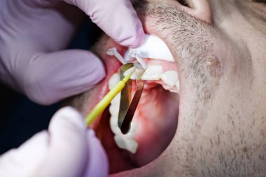 Diş hekimi hastaya ön diş tedavisi uygular.