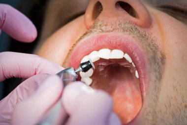  Dişçi hastanın ön dişlerini gıcırdatır.