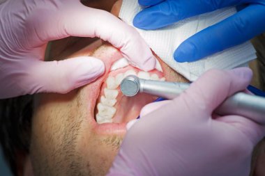 Dişçi hastanın ön dişlerini gıcırdatır.