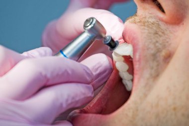 Dişçi hastanın ön dişlerini gıcırdatır.