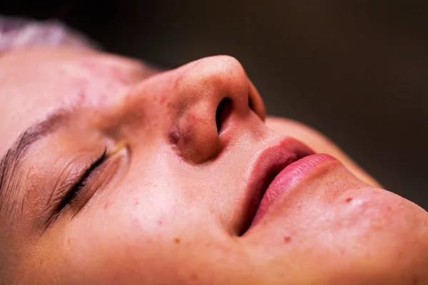 stock image close-up face of a young girl with acne before cleaning her face. horizontal