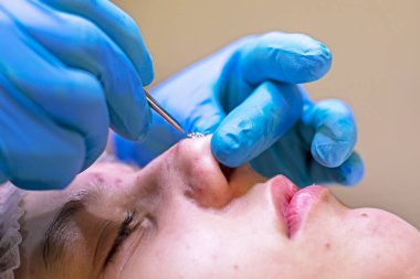 Kozmetik uzmanı özel bir aletle burundan siyah noktalar çıkarıyor..