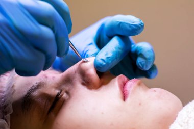 Kozmetik uzmanı özel bir aletle burundan siyah noktalar çıkarıyor..