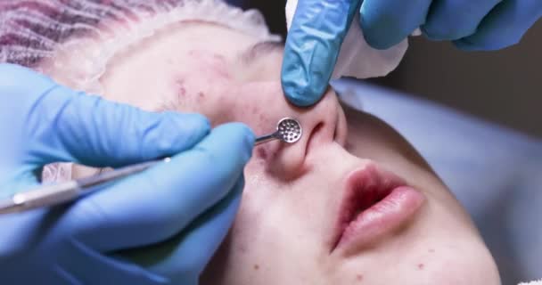 Kosmetolog Odstraňuje Černé Tečky Nosu Speciálním Nástrojem Dospívající Dívky Horizontální — Stock video
