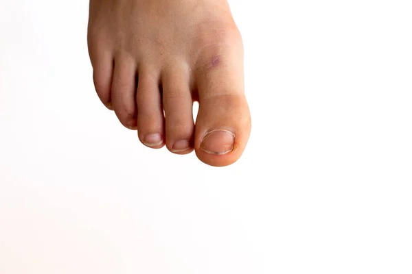 right foot close-up on a white background. Diseases of the nails and bones, padagra
