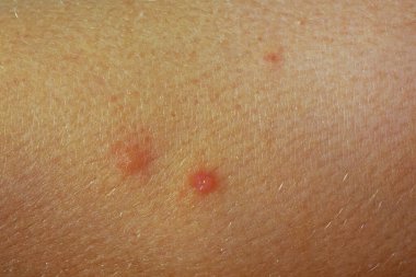 Deride komoro ısırıkları var. Alerjik reaksiyon. Deri iltihabı. Deri hastalıklarının tedavisi ve hastalıklar