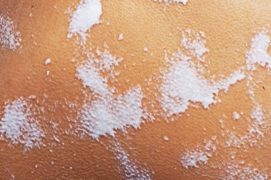 Açık tene güneş kremi sür. vücut bakımı