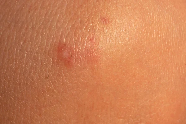 Close Insect Bites Skin Allergic Reaction Skin — Stock Photo, Image