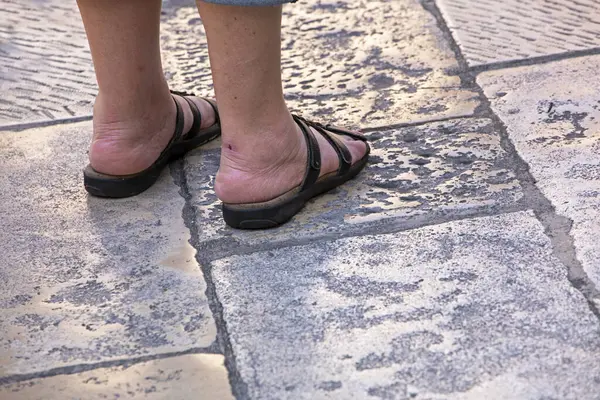 swollen feet of an elderly woman in flip-flops stand on shiny masonry