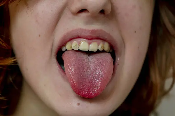 Gadis Remaja Membuka Mulutnya Saat Batuk Menjulurkan Lidahnya — Stok Foto