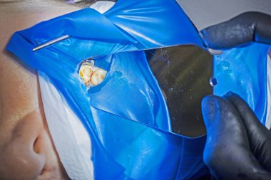 Hastanın dişi dolmadan önce delik deşik oluyor.