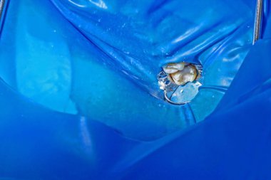 Diş muayenehanesinde dişleri üst üste dolmuş.